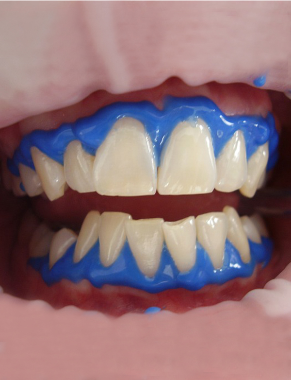 Tooth whitening Kenmore denitst