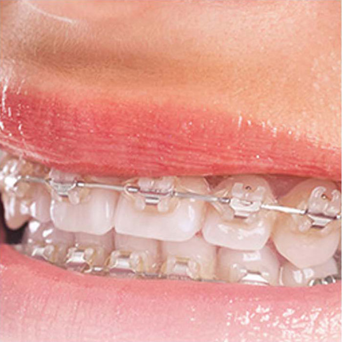 Adult Orthodontics and Braces