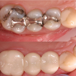 before and after amalgam removal