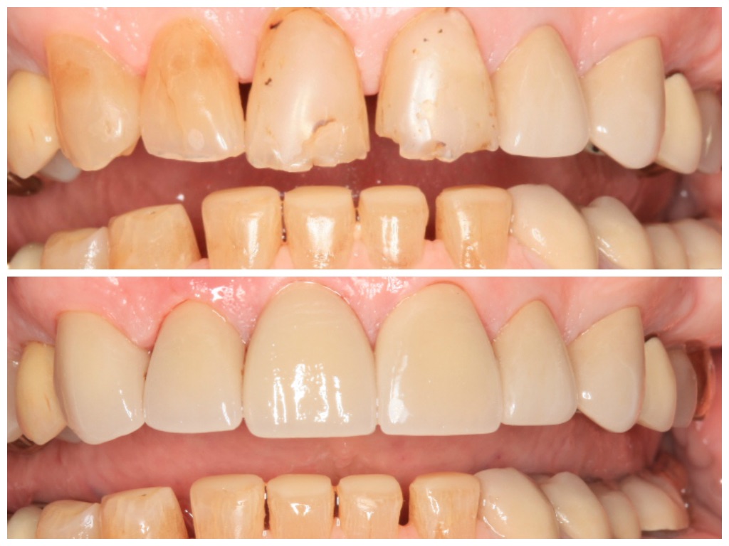 Crowns Before and After