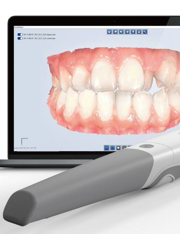 3D Scans Invisalign Kenmore Dentist