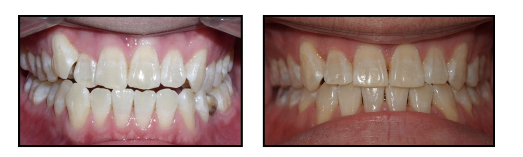 clear braces dentist kenmore