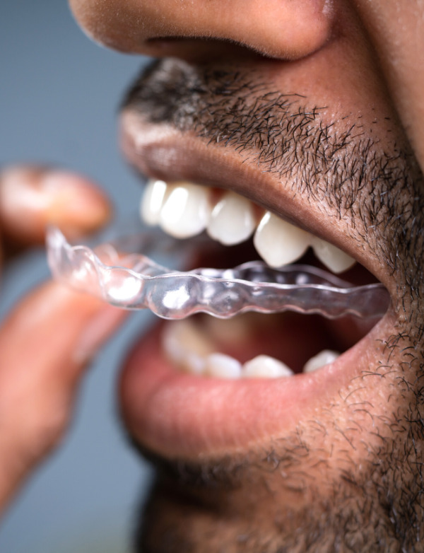 clear aligners dentist Kenmore