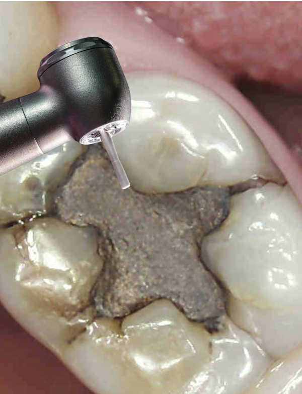 holistic approach to mercury fillings